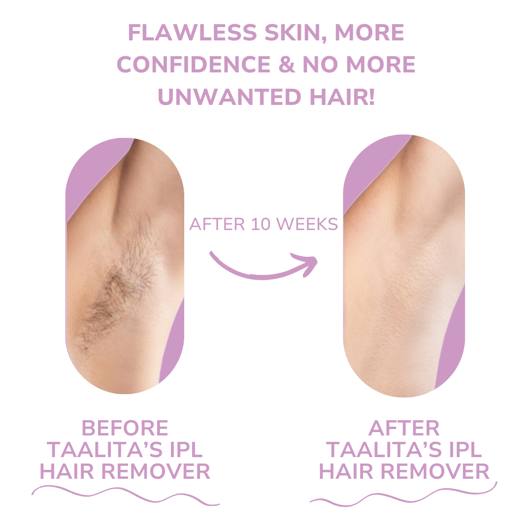IPL Hair Remover™ - Pain-Free Path to Smooth Skin